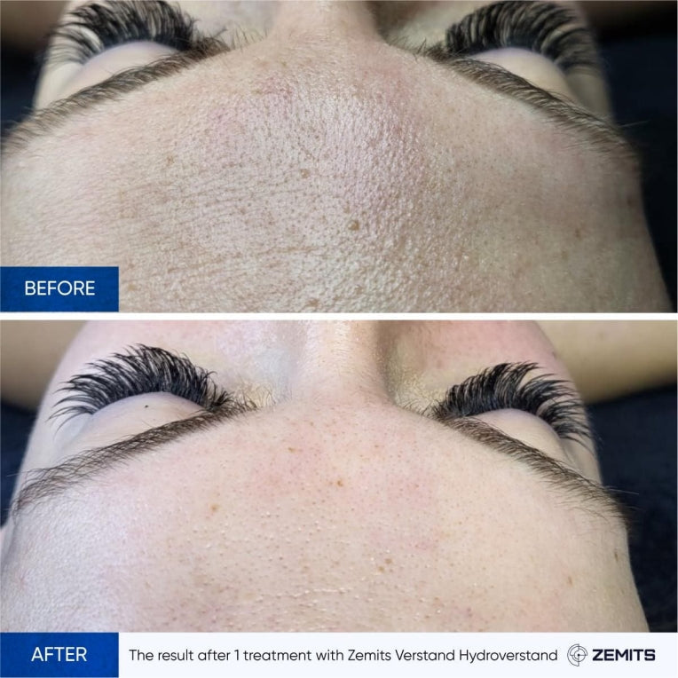 Zemits HydroVerstand PRO Sistema HydroDiamond™ 7 en 1