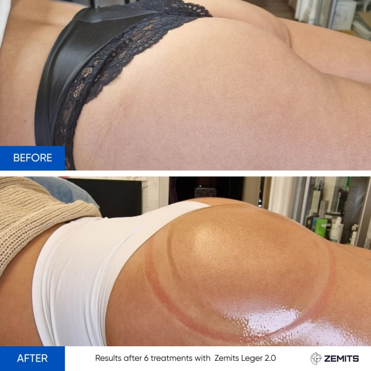 Zemits Leger 2.0 Sistema de Ventosas al Vacío con Copas XXL en el Conjunto