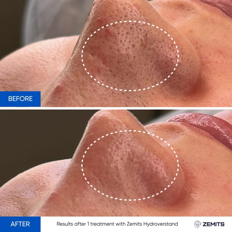 Zemits HydroVerstand PRO Sistema HydroDiamond™ 7 en 1